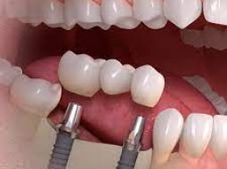 Протезирование зубов на Академической — преимущества процедуры
