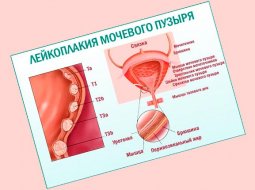 Лейкоплакия мочевого пузыря: симптомы, причины, лечение
