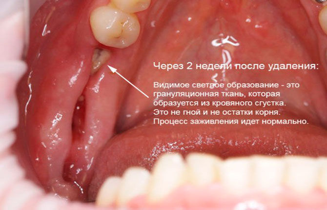 Альвеола после удаления зуба